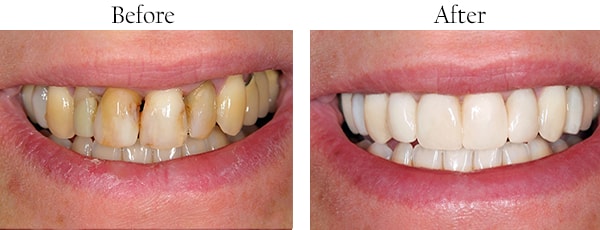 Wallington Before and After Smile Makeover Images