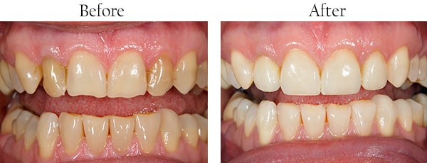 Wallington Before and After Smile Makeover Images