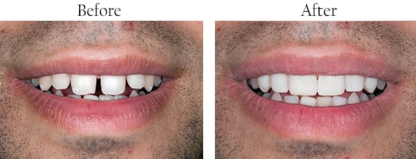 Wallington Before and After Smile Makeover Images