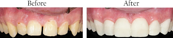 Wallington Before and After Smile Makeover Images