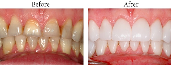 Wallington Before and After Smile Makeover Images