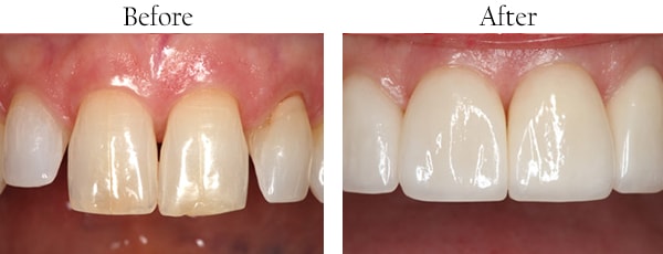 Wallington Before and After Smile Makeover Images