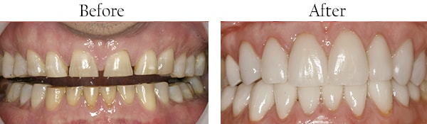 Wallington Before and After Smile Makeover Images