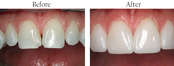 Wallington Before and After Smile Makeover Images